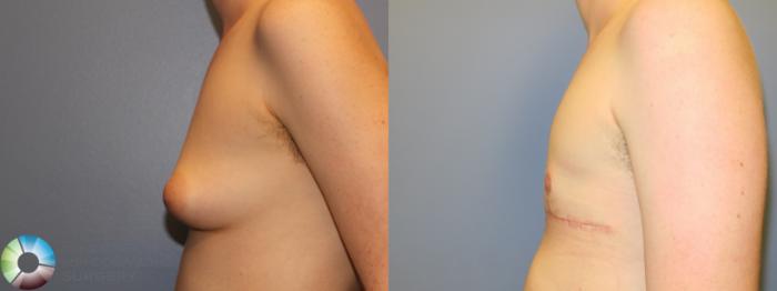 Before & After FTM Top Surgery/Chest Masculinization Case 11542 Left Side in Denver and Colorado Springs, CO