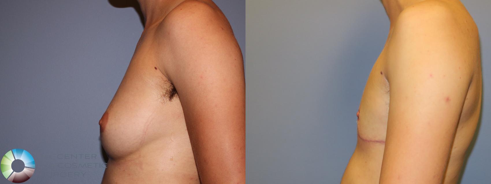 Before & After FTM Top Surgery/Chest Masculinization Case 11543 Left Side in Denver and Colorado Springs, CO