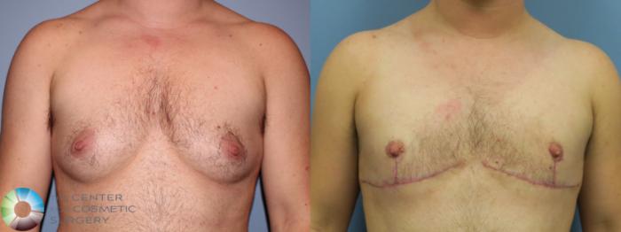 Before & After FTM Top Surgery/Chest Masculinization Case 11544 Front in Denver and Colorado Springs, CO