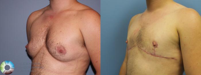 Before & After FTM Top Surgery/Chest Masculinization Case 11544 Left Oblique in Denver and Colorado Springs, CO