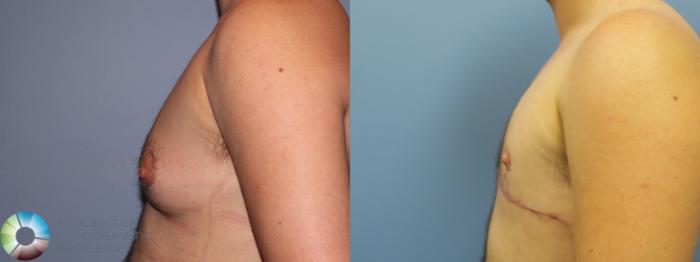 Before & After FTM Top Surgery/Chest Masculinization Case 11544 Left Side in Denver and Colorado Springs, CO