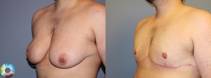 Before & After FTM Top Surgery/Chest Masculinization Case 11545 Left Oblique in Denver and Colorado Springs, CO