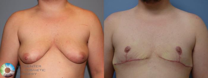 Before & After FTM Top Surgery/Chest Masculinization Case 11546 Front in Denver and Colorado Springs, CO