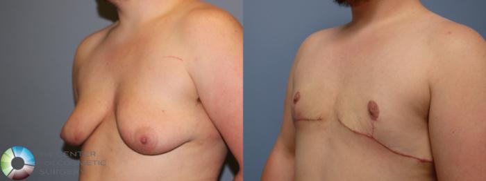 Before & After FTM Top Surgery/Chest Masculinization Case 11546 Left Oblique in Denver and Colorado Springs, CO