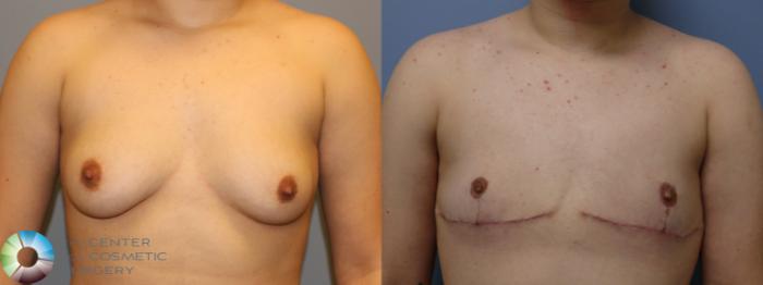 Before & After FTM Top Surgery/Chest Masculinization Case 11547 Front in Denver and Colorado Springs, CO