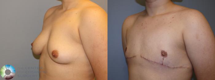 Before & After FTM Top Surgery/Chest Masculinization Case 11547 Left Oblique in Denver and Colorado Springs, CO