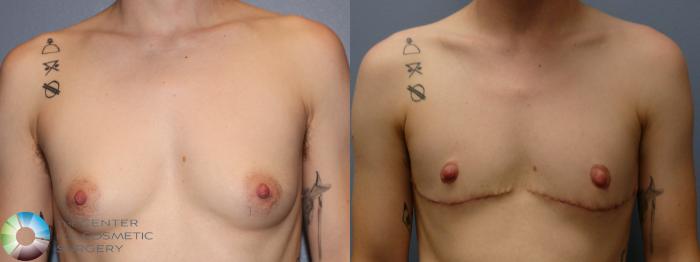 Before & After FTM Top Surgery/Chest Masculinization Case 11643 Front in Denver, CO