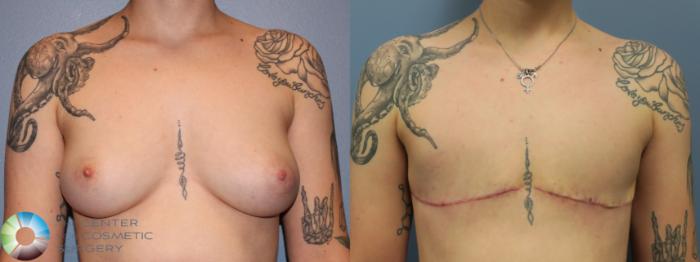 Before & After FTM Top Surgery/Chest Masculinization Case 11644 Front in Denver, CO