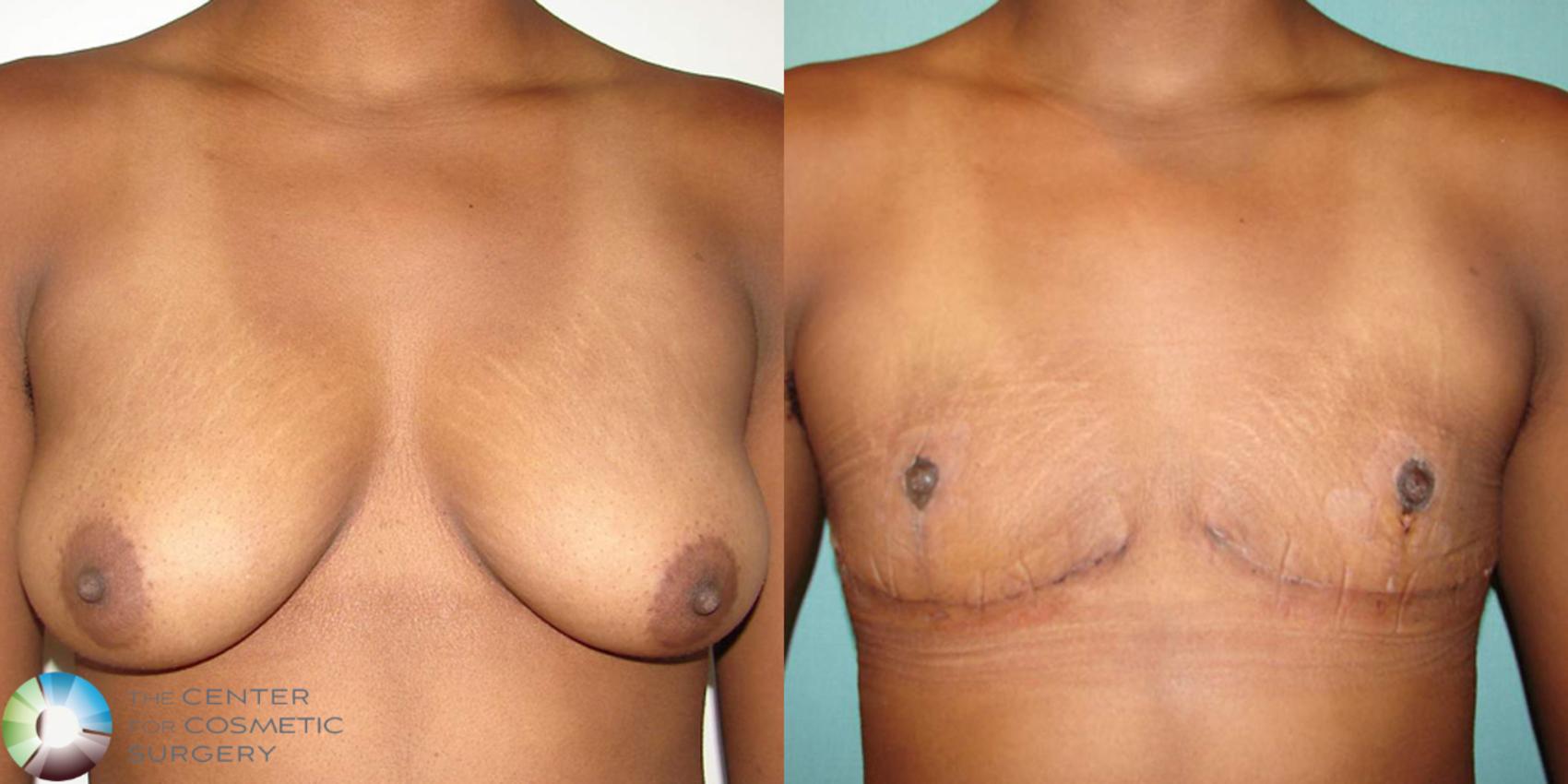 Before & After FTM Top Surgery/Chest Masculinization Case 506 View #1 in Denver, CO
