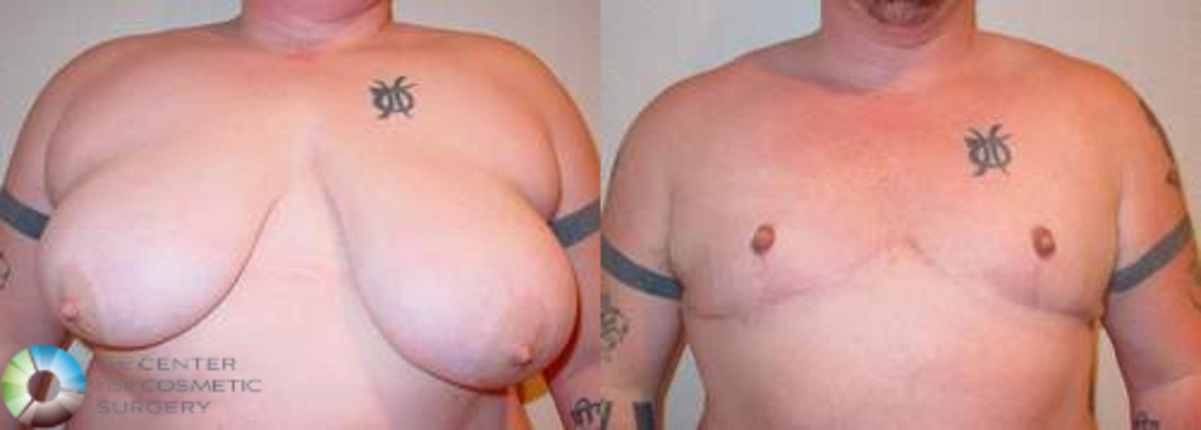 Before & After FTM Top Surgery/Chest Masculinization Case 559 View #1 in Denver and Colorado Springs, CO