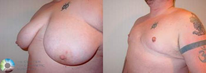 Before & After FTM Top Surgery/Chest Masculinization Case 559 View #2 in Denver and Colorado Springs, CO
