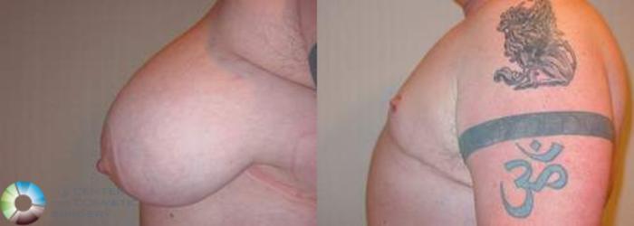 Before & After FTM Top Surgery/Chest Masculinization Case 559 View #3 in Denver and Colorado Springs, CO