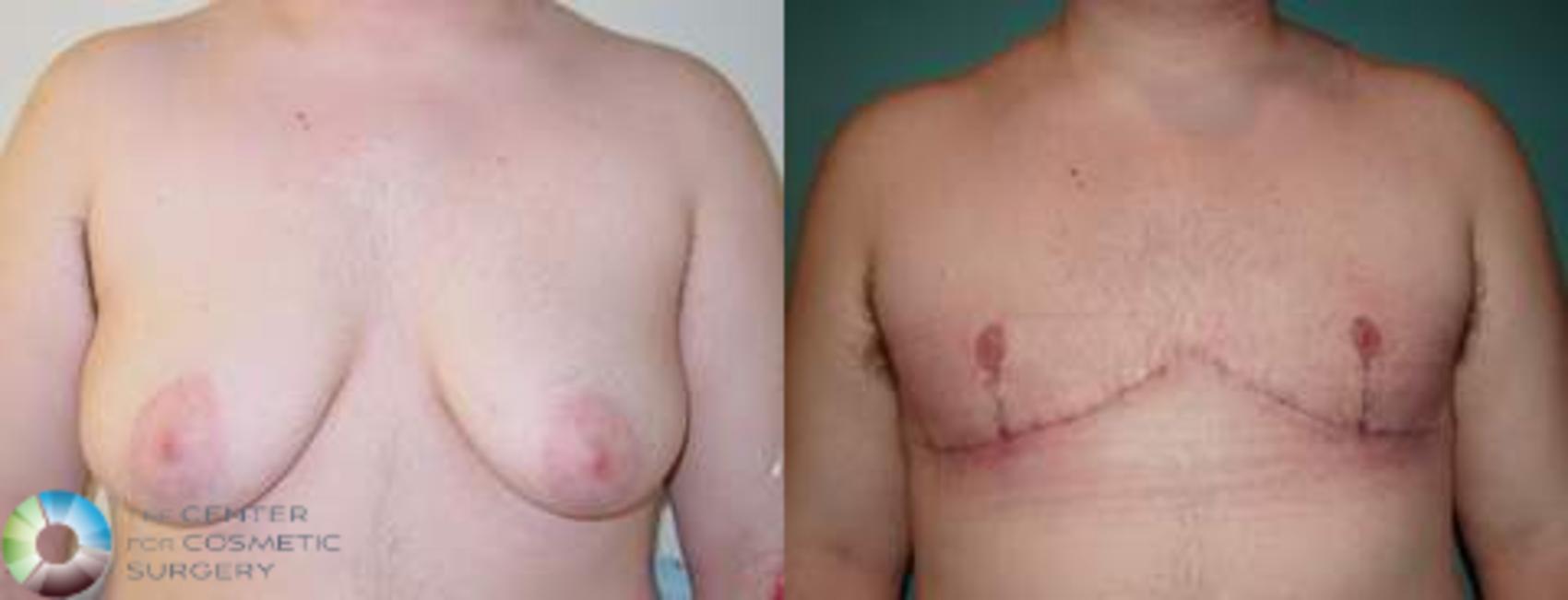 Before & After FTM Top Surgery/Chest Masculinization Case 560 View #1 in Denver, CO