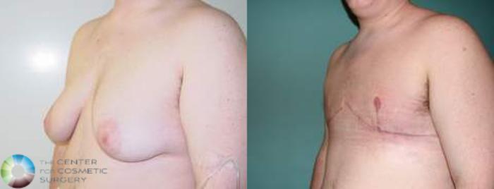 Before & After FTM Top Surgery/Chest Masculinization Case 560 View #2 in Denver, CO