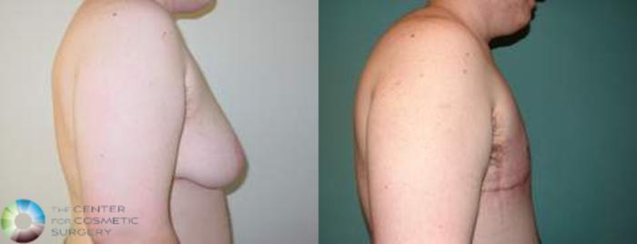 Before & After FTM Top Surgery/Chest Masculinization Case 560 View #3 in Denver, CO