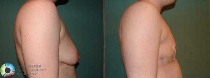Before & After FTM Top Surgery/Chest Masculinization Case 561 Right Side in Denver, CO