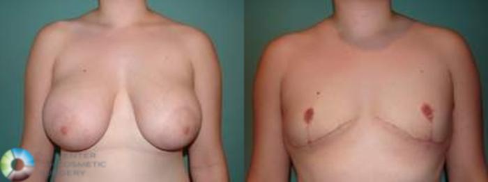 Before & After FTM Top Surgery/Chest Masculinization Case 562 Anterior in Denver, CO