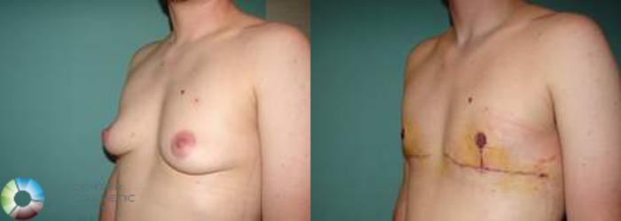 Before & After FTM Top Surgery/Chest Masculinization Case 563 View #2 in Denver and Colorado Springs, CO
