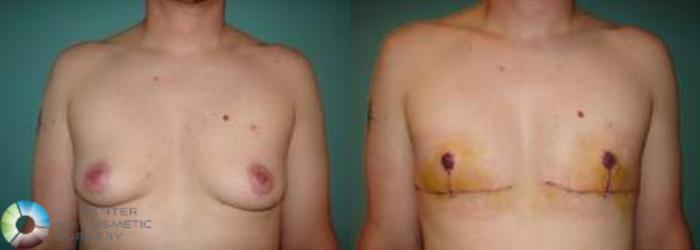 Before & After FTM Top Surgery/Chest Masculinization Case 563 View #3 in Denver and Colorado Springs, CO