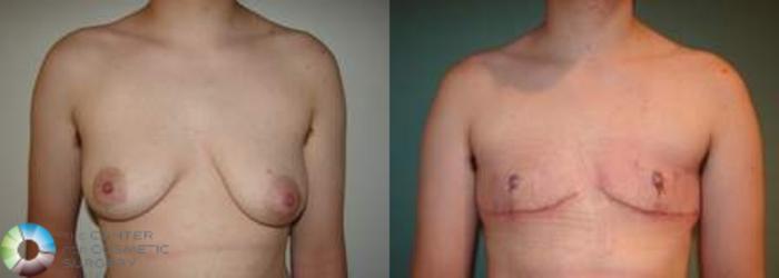 Before & After FTM Top Surgery/Chest Masculinization Case 564 Anterior in Denver and Colorado Springs, CO
