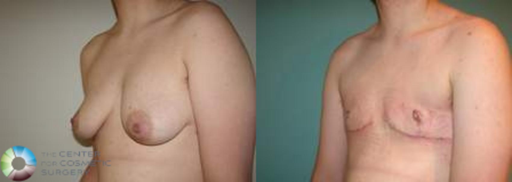 Before & After FTM Top Surgery/Chest Masculinization Case 564 Left Oblique in Denver and Colorado Springs, CO