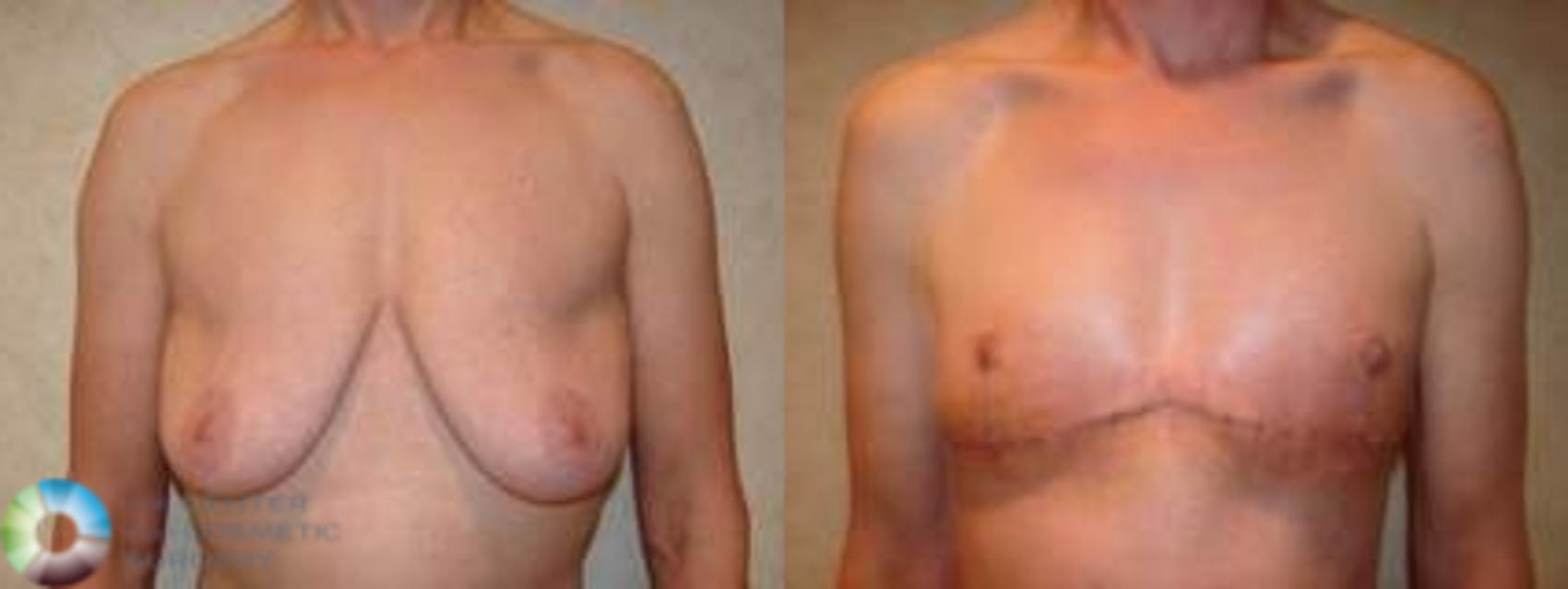 Before & After FTM Top Surgery/Chest Masculinization Case 565 Anterior in Denver and Colorado Springs, CO