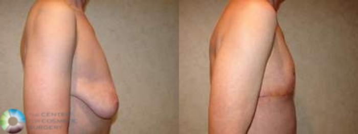 Before & After FTM Top Surgery/Chest Masculinization Case 565 Right Lateral in Denver and Colorado Springs, CO