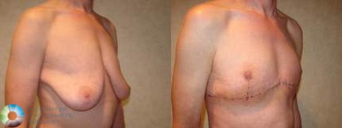 Before & After FTM Top Surgery/Chest Masculinization Case 565 Right Oblique in Denver and Colorado Springs, CO
