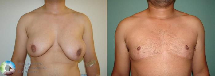 Before & After FTM Top Surgery/Chest Masculinization Case 566 View #1 in Denver and Colorado Springs, CO