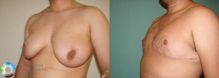 Before & After FTM Top Surgery/Chest Masculinization Case 566 View #2 in Denver and Colorado Springs, CO