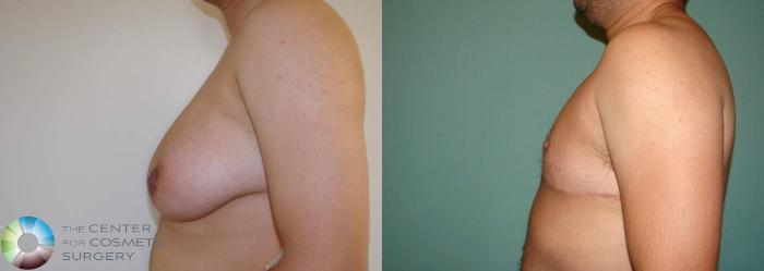 Before & After FTM Top Surgery/Chest Masculinization Case 566 View #3 in Denver and Colorado Springs, CO