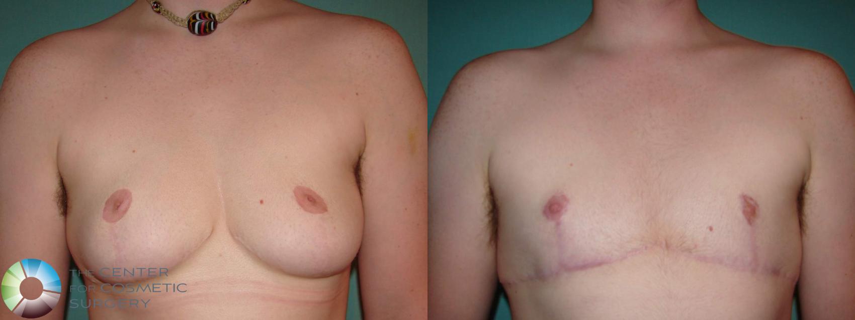 Before & After FTM Top Surgery/Chest Masculinization Case 609 Anterior in Denver and Colorado Springs, CO