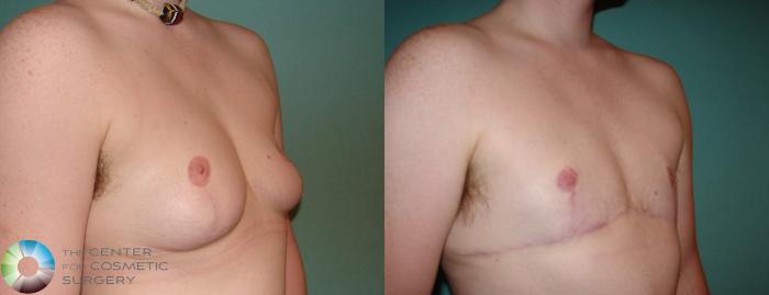 Before & After FTM Top Surgery/Chest Masculinization Case 609 Right Oblique in Denver and Colorado Springs, CO