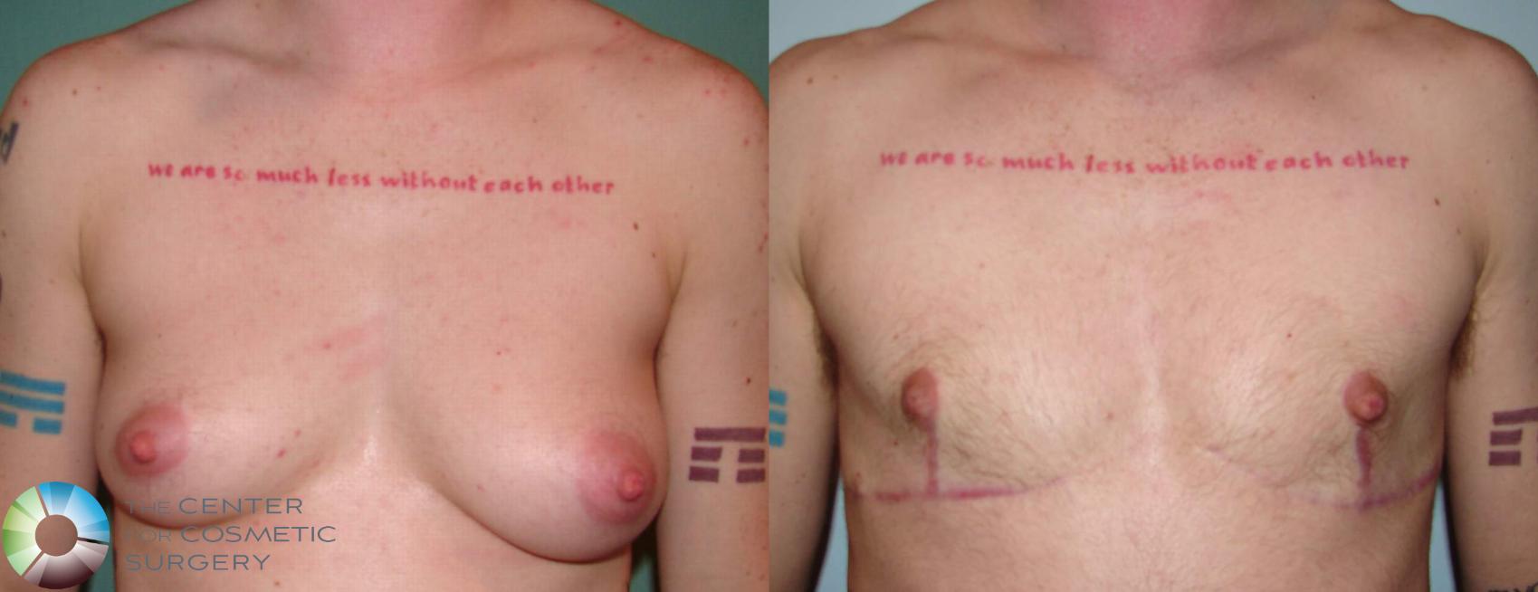 Before & After FTM Top Surgery/Chest Masculinization Case 610 Anterior in Denver, CO
