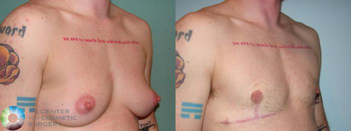 Before & After FTM Top Surgery/Chest Masculinization Case 610 Right Oblique in Denver, CO