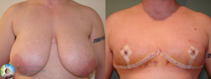 Before & After FTM Top Surgery/Chest Masculinization Case 611 Anterior in Denver and Colorado Springs, CO