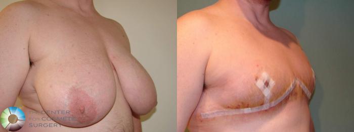 Before & After FTM Top Surgery/Chest Masculinization Case 611 Right Oblique in Denver and Colorado Springs, CO
