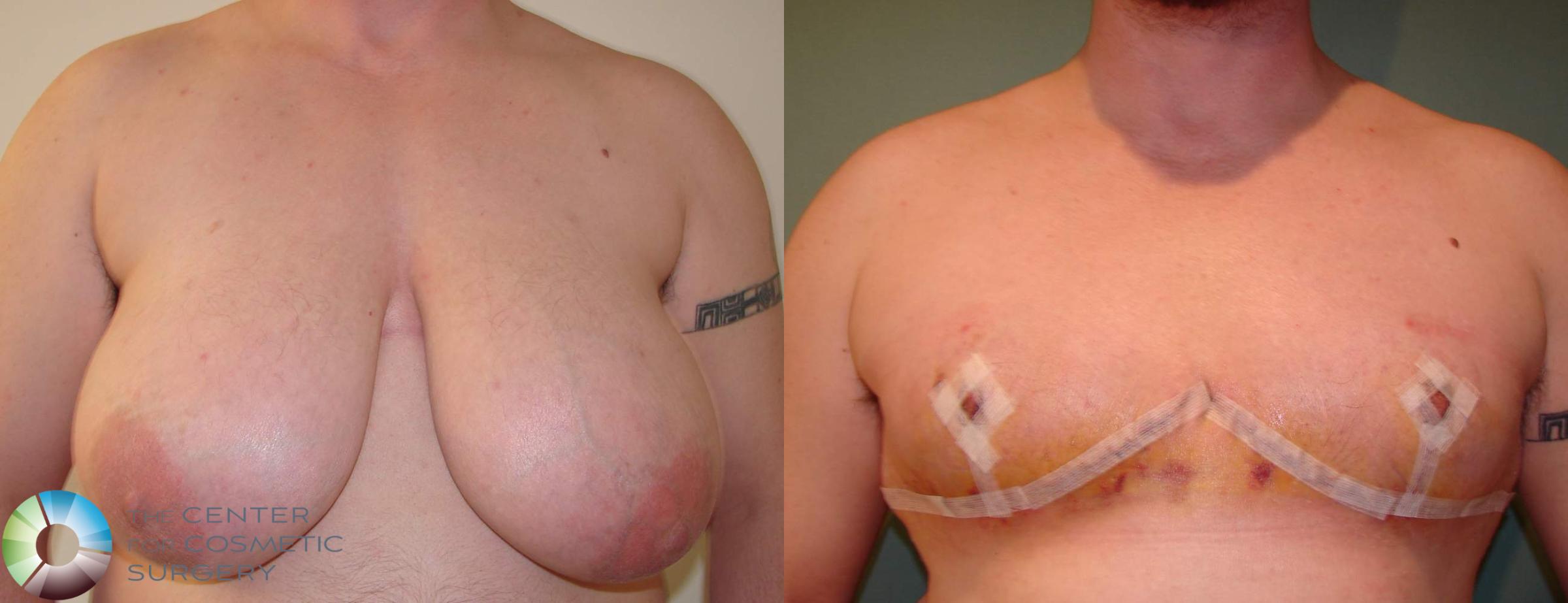 FTM Top Surgery/Chest Masculinization Case 611 Before & After View #1 | Golden, CO | The Center for Cosmetic Surgery