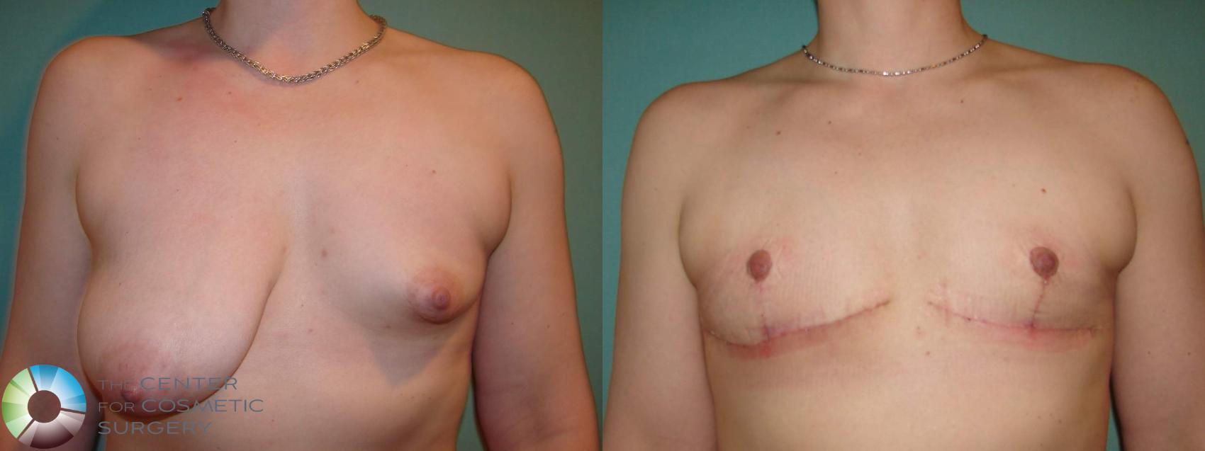 Before & After FTM Top Surgery/Chest Masculinization Case 622 Anterior in Denver and Colorado Springs, CO