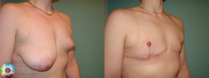 Before & After FTM Top Surgery/Chest Masculinization Case 622 Right Oblique in Denver and Colorado Springs, CO
