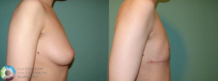 Before & After FTM Top Surgery/Chest Masculinization Case 643 Right Lateral in Denver, CO