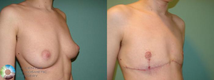 Before & After FTM Top Surgery/Chest Masculinization Case 643 Right Oblique in Denver, CO