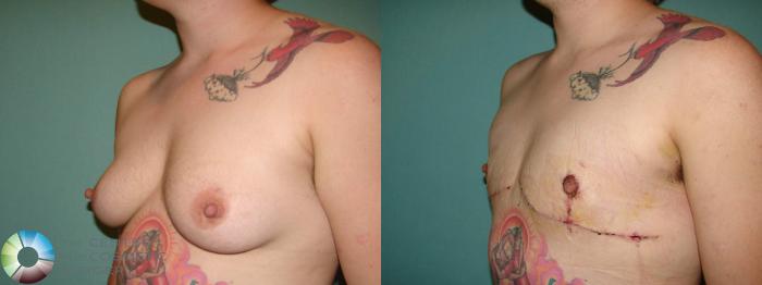 Before & After FTM Top Surgery/Chest Masculinization Case 649 Left Oblique in Denver, CO