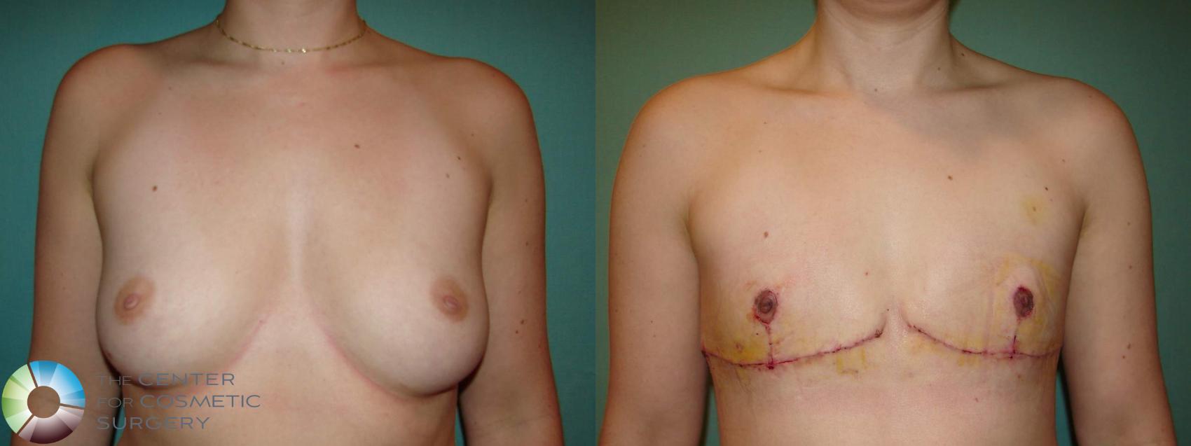 Before & After FTM Top Surgery/Chest Masculinization Case 651 Anterior in Denver, CO