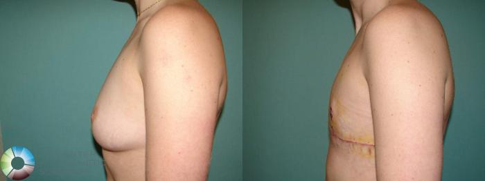 Before & After FTM Top Surgery/Chest Masculinization Case 651 Left Lateral in Denver, CO