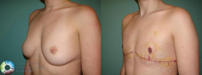 Before & After FTM Top Surgery/Chest Masculinization Case 651 Left Oblique in Denver, CO
