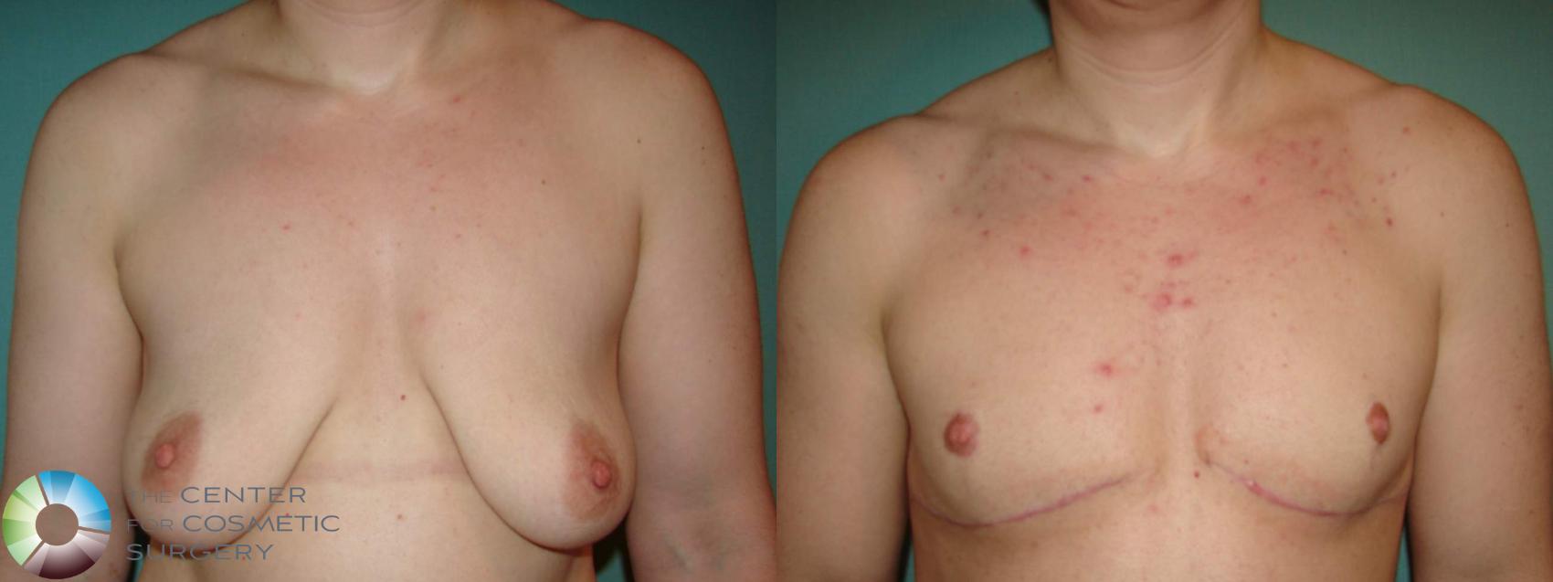 Before & After FTM Top Surgery/Chest Masculinization Case 658 Anterior in Denver and Colorado Springs, CO