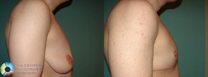 Before & After FTM Top Surgery/Chest Masculinization Case 658 Right Lateral in Denver and Colorado Springs, CO