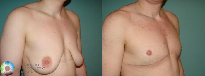 Before & After FTM Top Surgery/Chest Masculinization Case 658 Right Oblique in Denver and Colorado Springs, CO