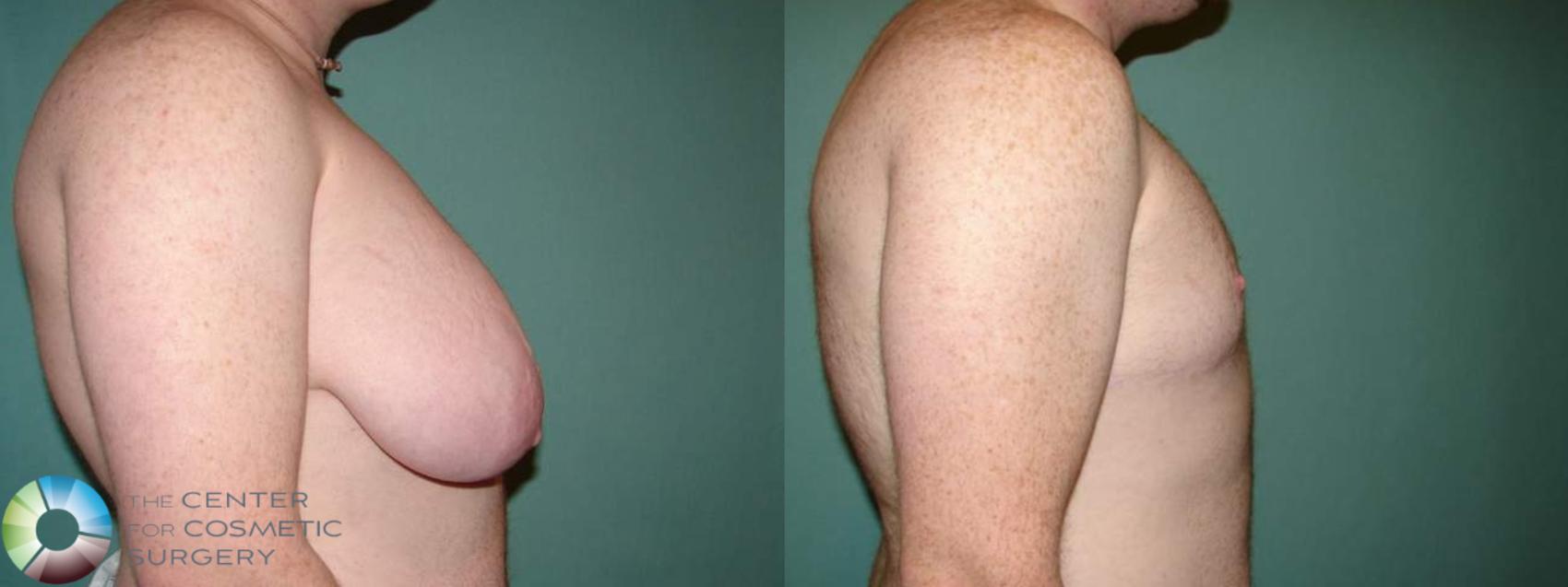 Before & After FTM Top Surgery/Chest Masculinization Case 663 Right Side in Denver and Colorado Springs, CO